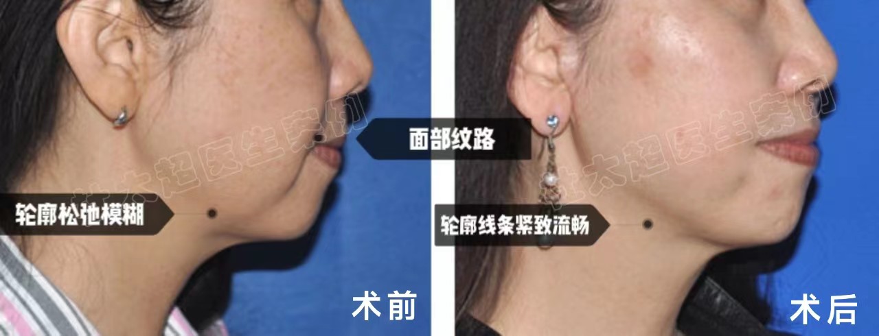 63岁做二次拉皮，活成令人羡慕的小女人，分享2点经验