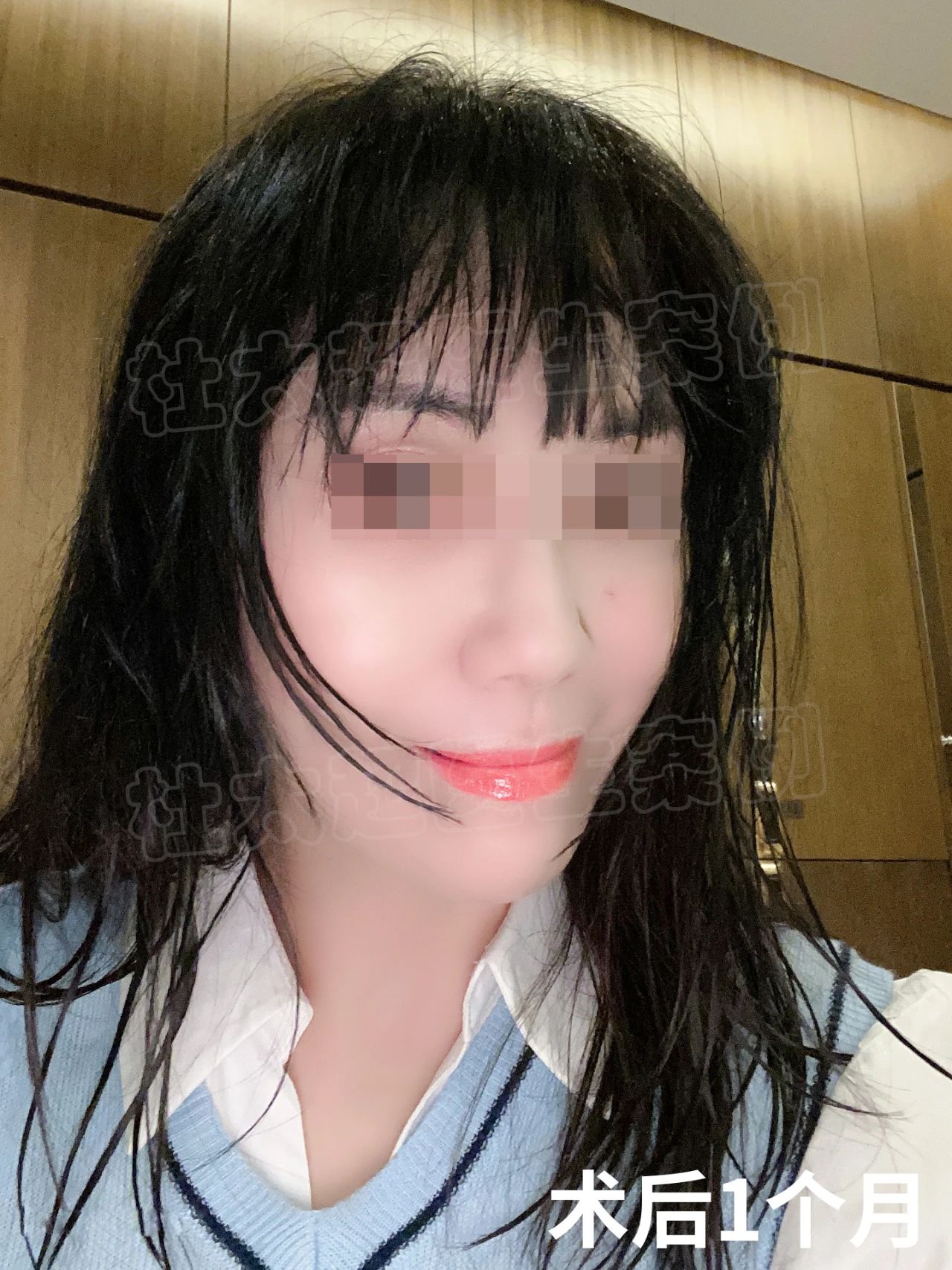 50岁拉皮手术蜕变之旅，术后半年改变惊人，找回青春不是梦