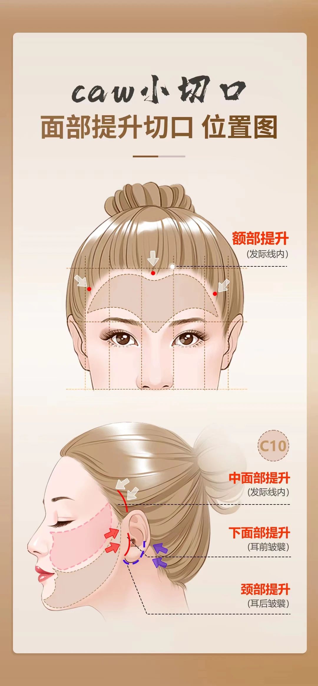 拉皮手术真的那么可怕吗？