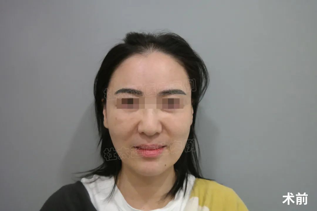 52岁选择拉皮手术，只有过来人才知道，效果变化真的大！