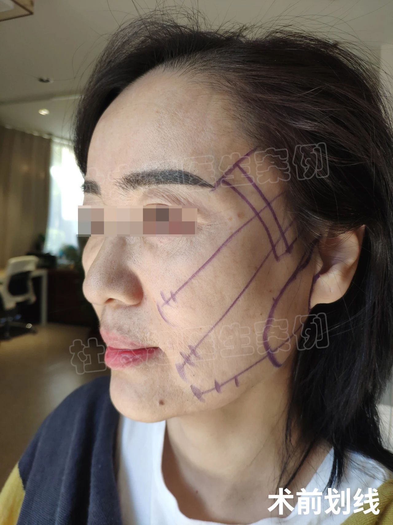 52岁选择拉皮手术，只有过来人才知道，效果变化真的大！