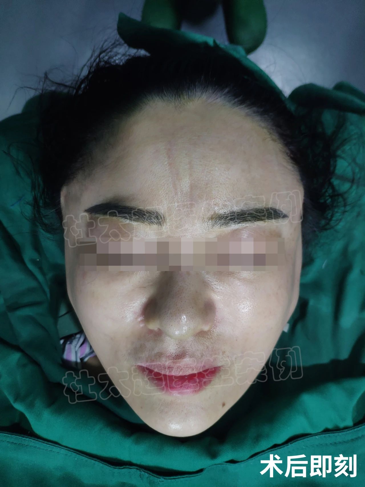 52岁选择拉皮手术，只有过来人才知道，效果变化真的大！