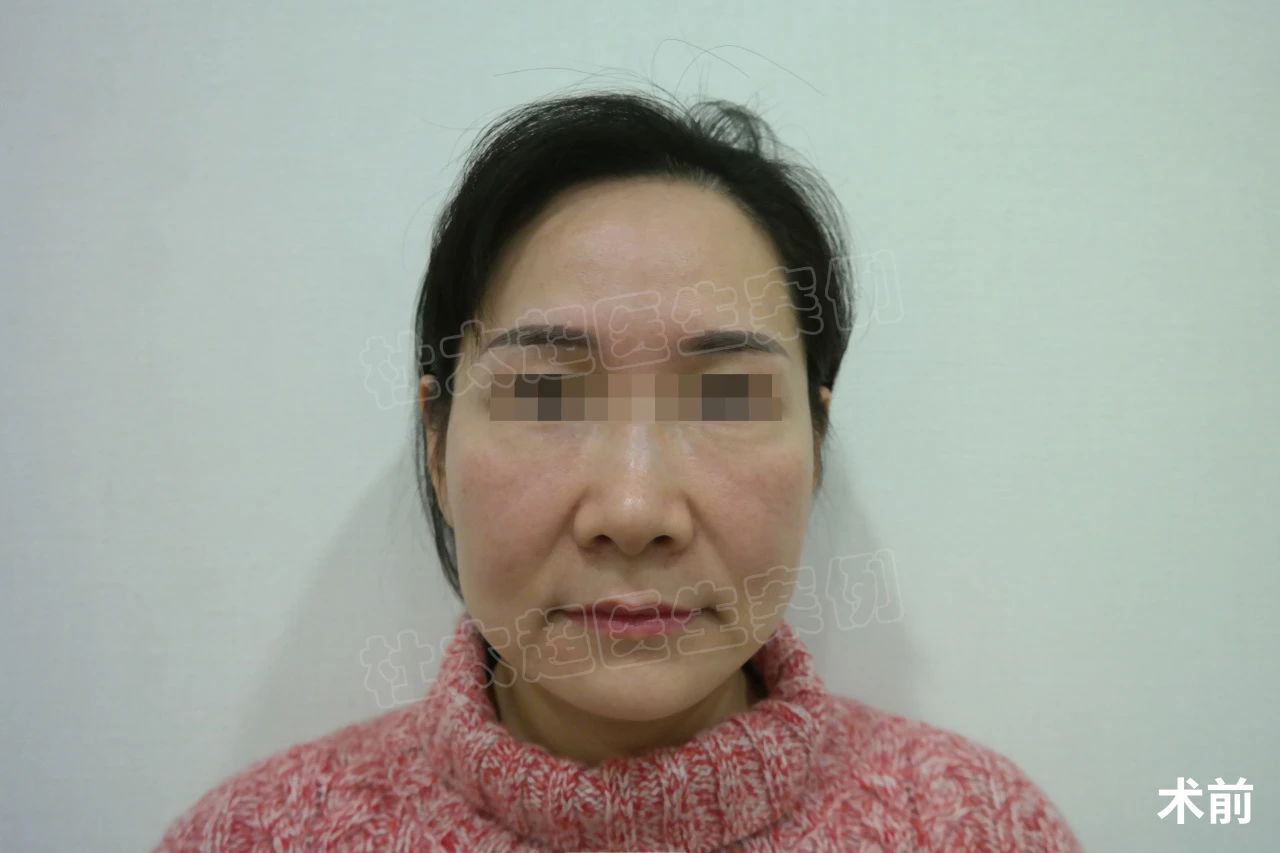 47岁做完拉皮，一周照镜子没敢认，变化确实很大