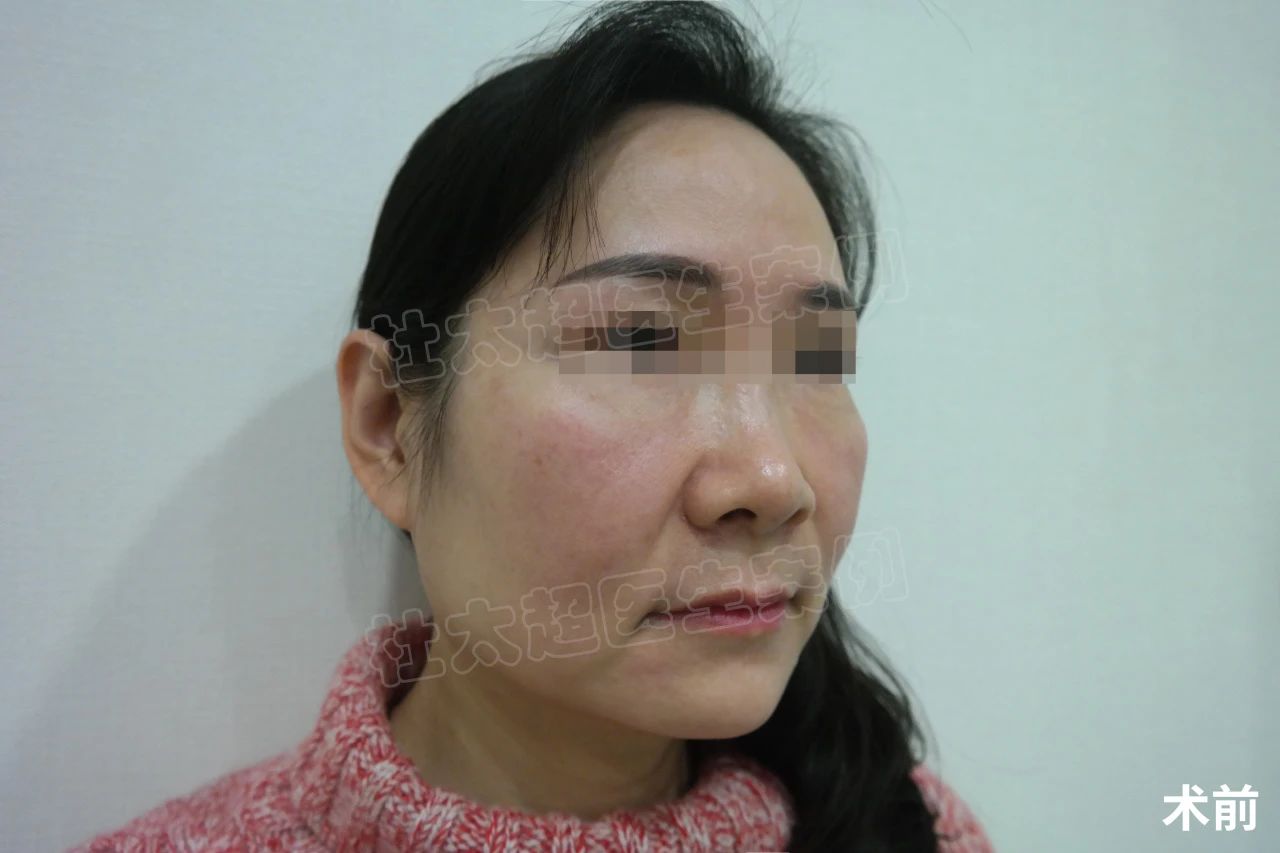 47岁做完拉皮，一周照镜子没敢认，变化确实很大