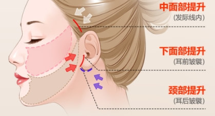 53岁狠心做了拉皮提升，才知道原来我对拉皮手术的误解太深了