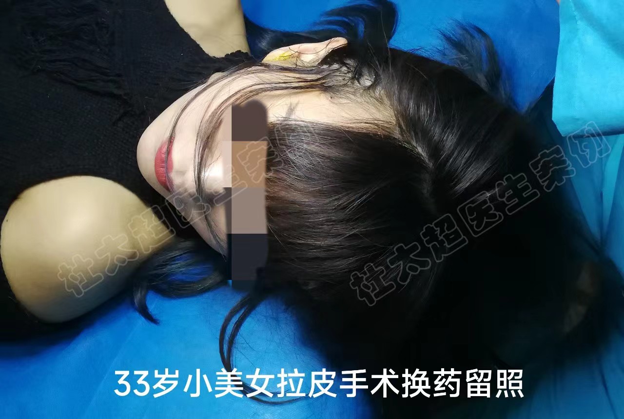 53岁狠心做了拉皮提升，才知道原来我对拉皮手术的误解太深了