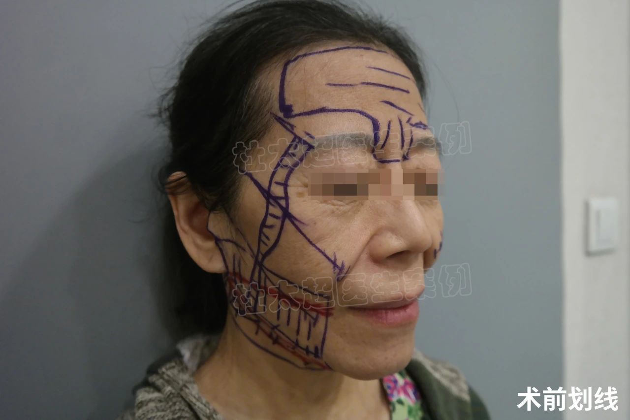 拉皮7天恢复成这样，看看她的经验分享，都是大实话！