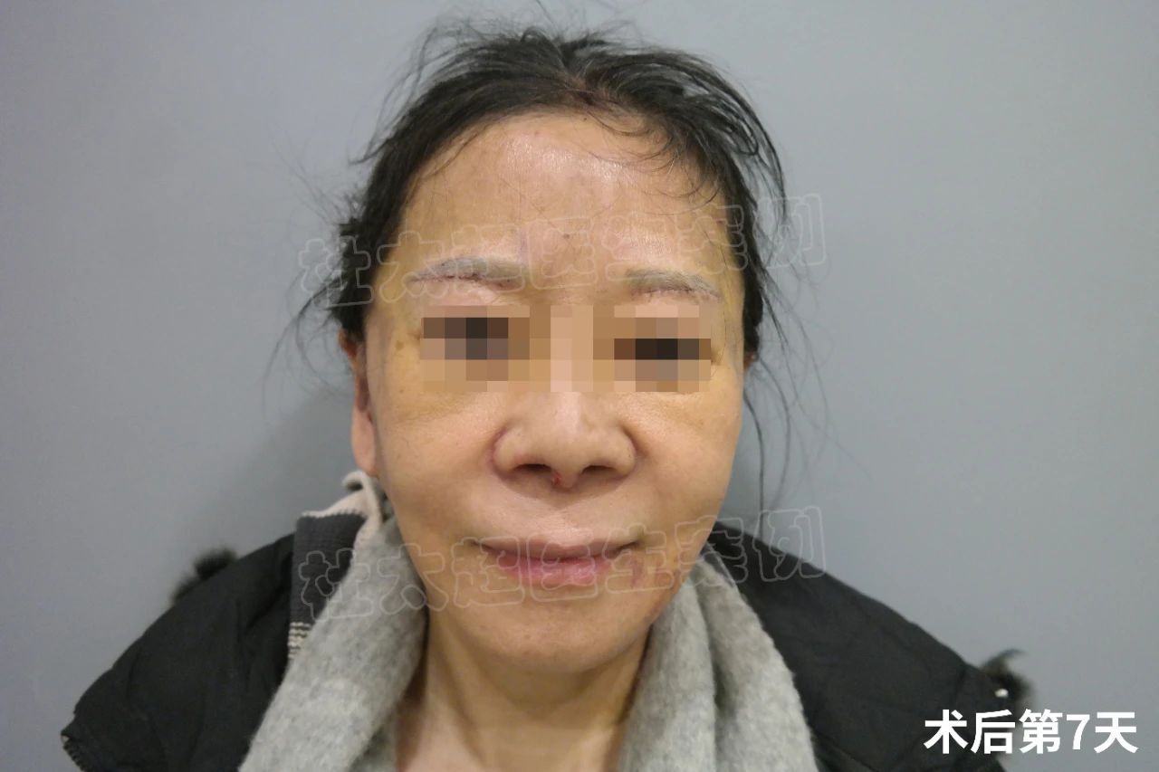 拉皮7天恢复成这样，看看她的经验分享，都是大实话！