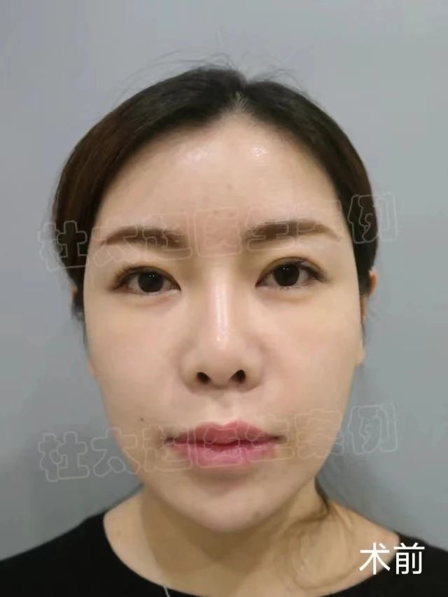 36岁抗初老，做了拉皮手术，术后自己很满意！