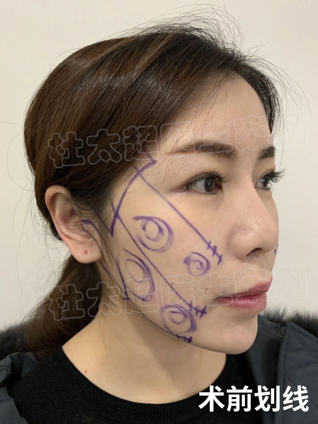 36岁抗初老，做了拉皮手术，术后自己很满意！