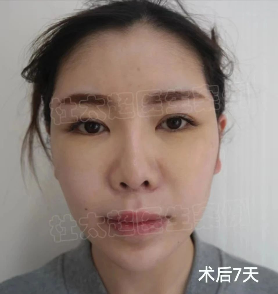 36岁抗初老，做了拉皮手术，术后自己很满意！