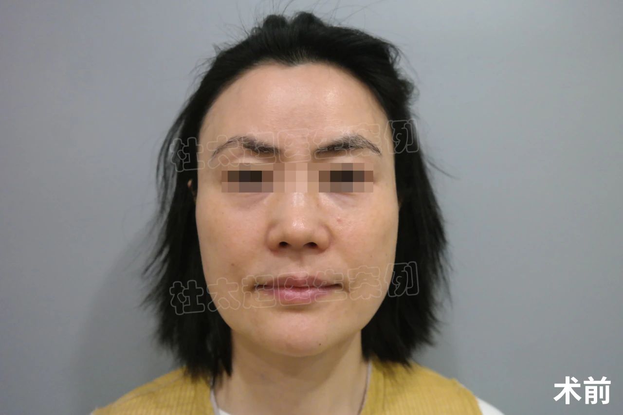 41岁求美者，做拉皮提升，术后效果很惊艳！