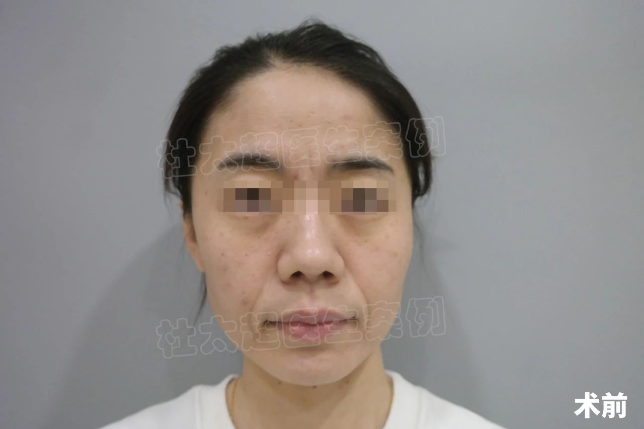 39岁拉皮手术，改善法令纹和面部松弛，一举两得！