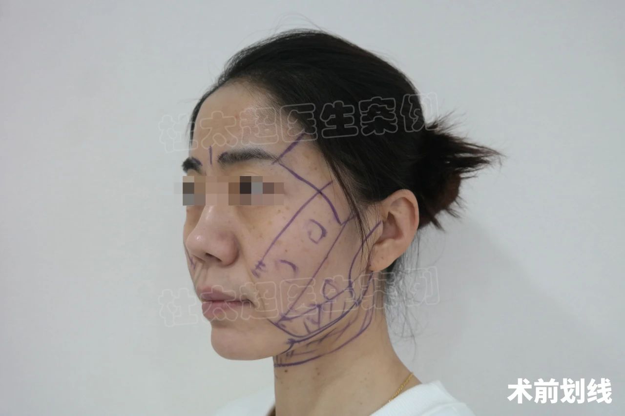 39岁拉皮手术，改善法令纹和面部松弛，一举两得！