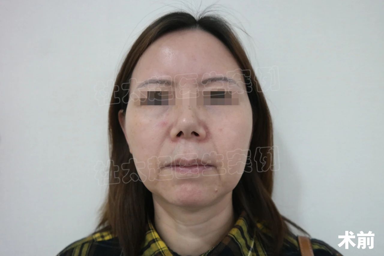 51岁挑战拉皮手术，术后1个月，感觉自己年轻10岁