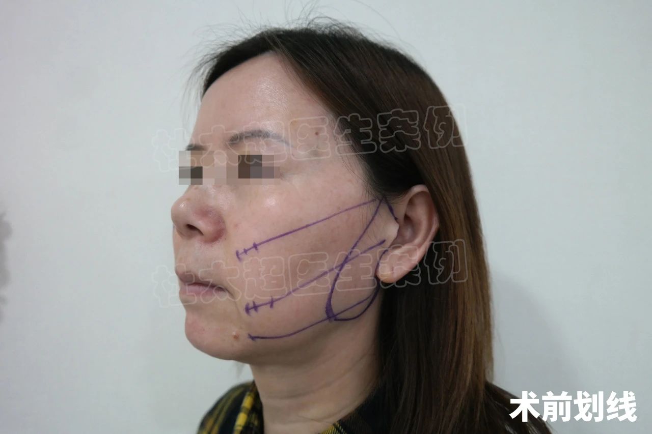 51岁挑战拉皮手术，术后1个月，感觉自己年轻10岁