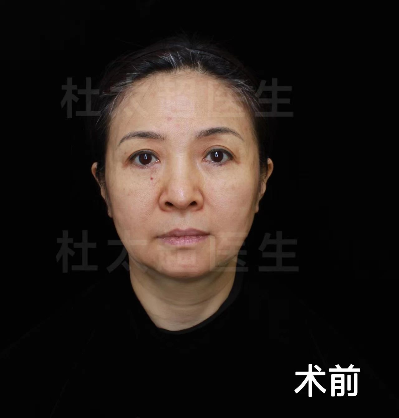 52岁做拉皮手术，告别面部松弛，让你重返年轻不是梦！