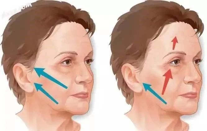 拉皮手术需要多长时间的恢复期? 拉皮手术需要多长时间的恢复期?