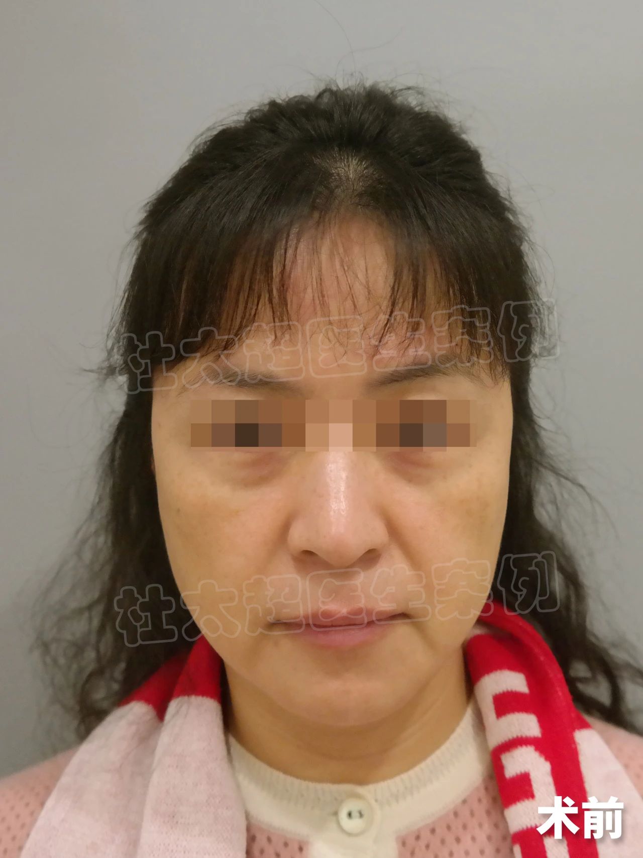 做拉皮会变成什么样,这是她术后的变化,找回了年轻自己! 做拉皮会变成什么样,这是她术后的变化,找回了年轻自己!