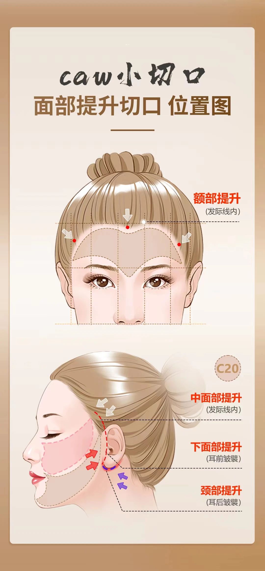 根据自己的面部基础来判断自己适合的拉皮术式，如果自己判断不清，可以寻求专业医生帮助，获取最适合自己的治疗方案。