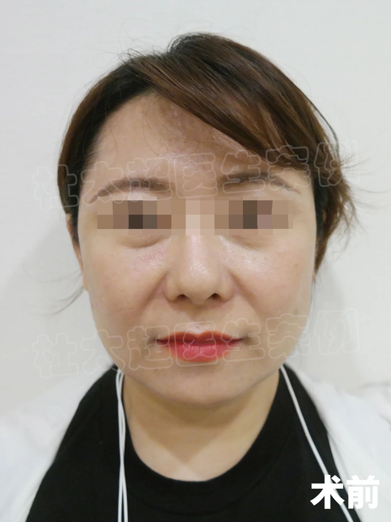 如今，距离手术过去已经一年时间，面部也早已恢复自然，现在的状态正是我追求的年轻感。所以呀，勇敢一点去改变自己，才会有机会收获更好的~