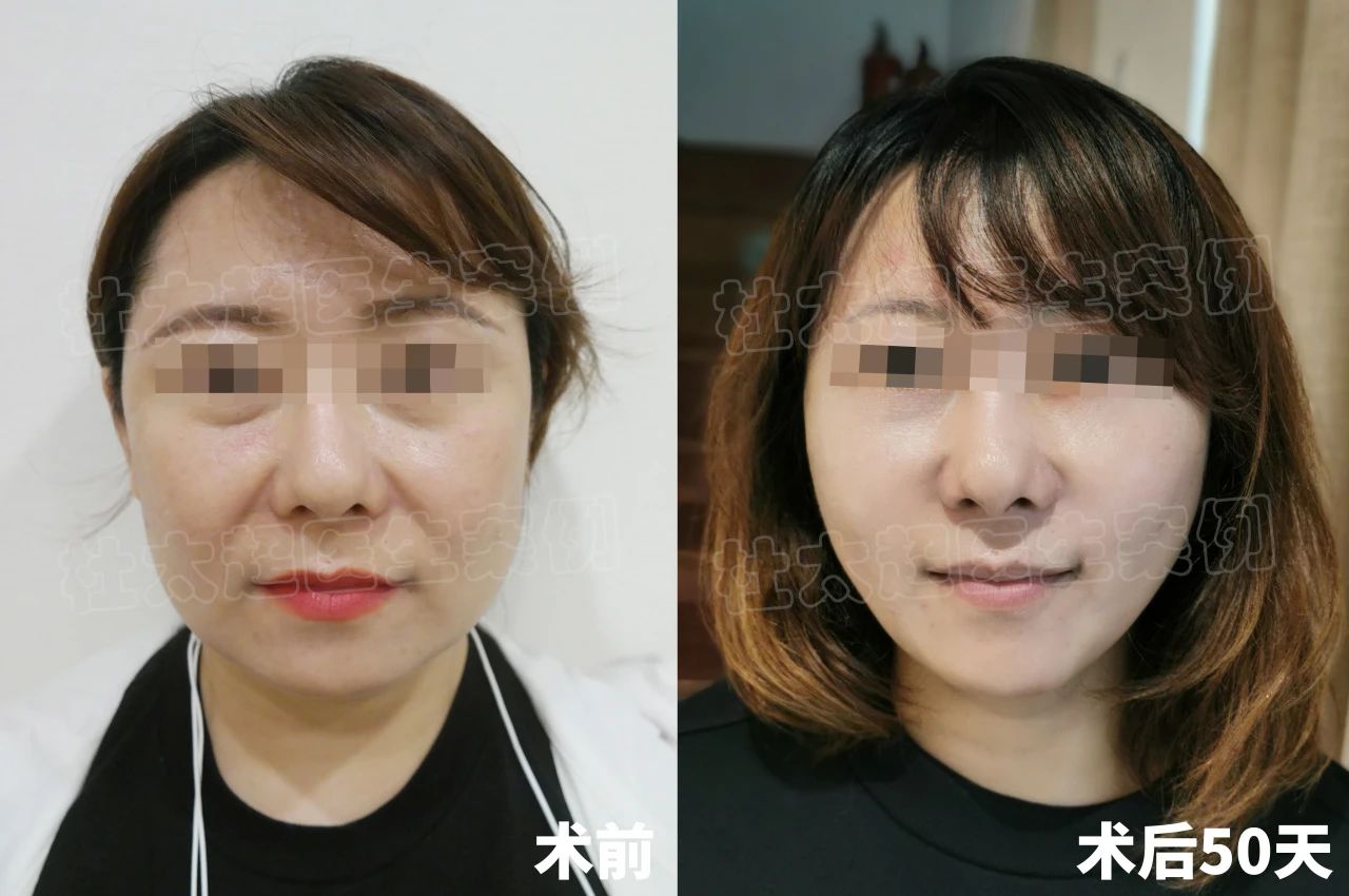 如今，距离手术过去已经一年时间，面部也早已恢复自然，现在的状态正是我追求的年轻感。所以呀，勇敢一点去改变自己，才会有机会收获更好的~