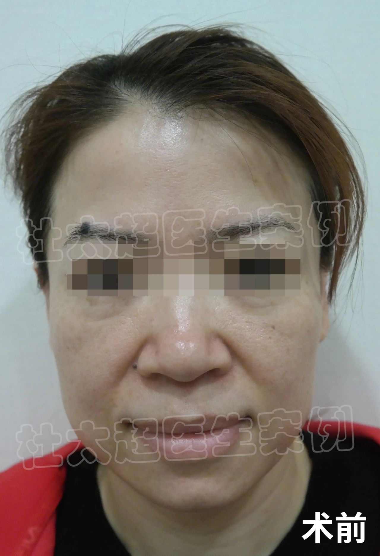 49岁求美者，做完拉皮手术很满意，直言60岁再做一次