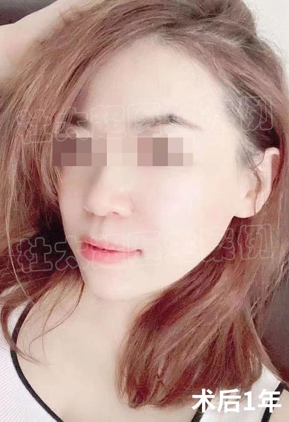 49岁求美者，做完拉皮手术很满意，直言60岁再做一次