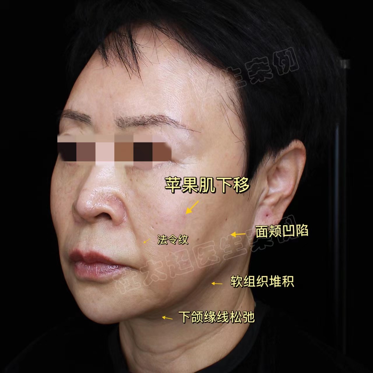 解决脸部皮肤松垂，最有效的方法是什么？求美者自述答案