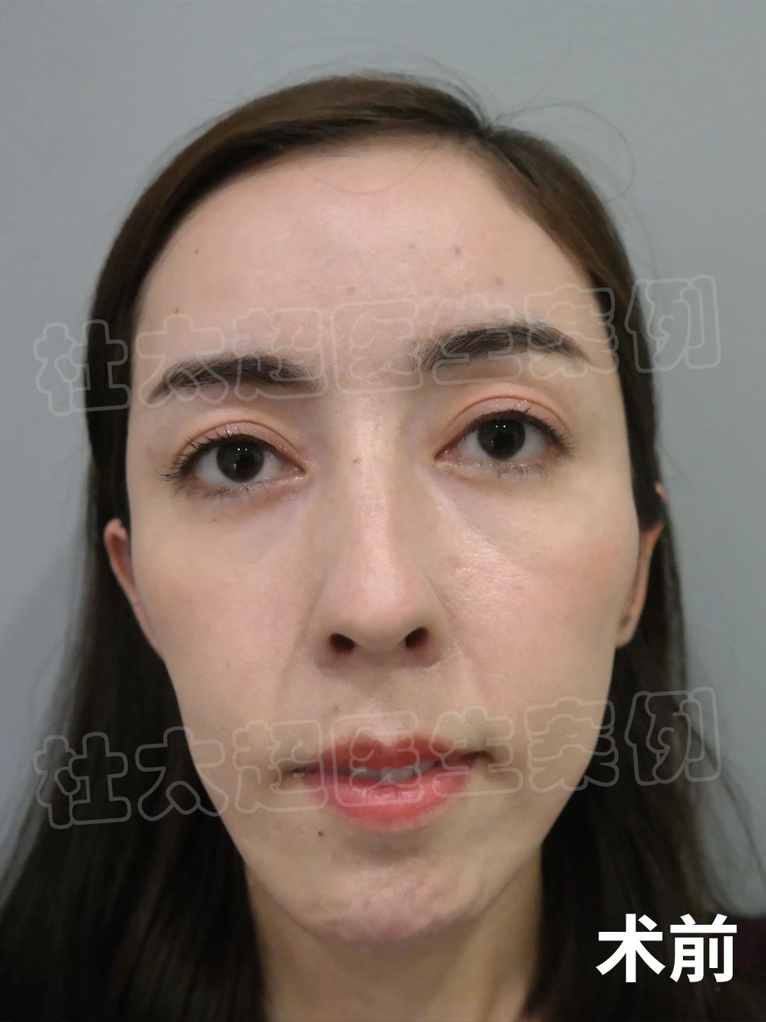 案例分享|看看29岁是如何通过拉皮手术做到冻龄的！