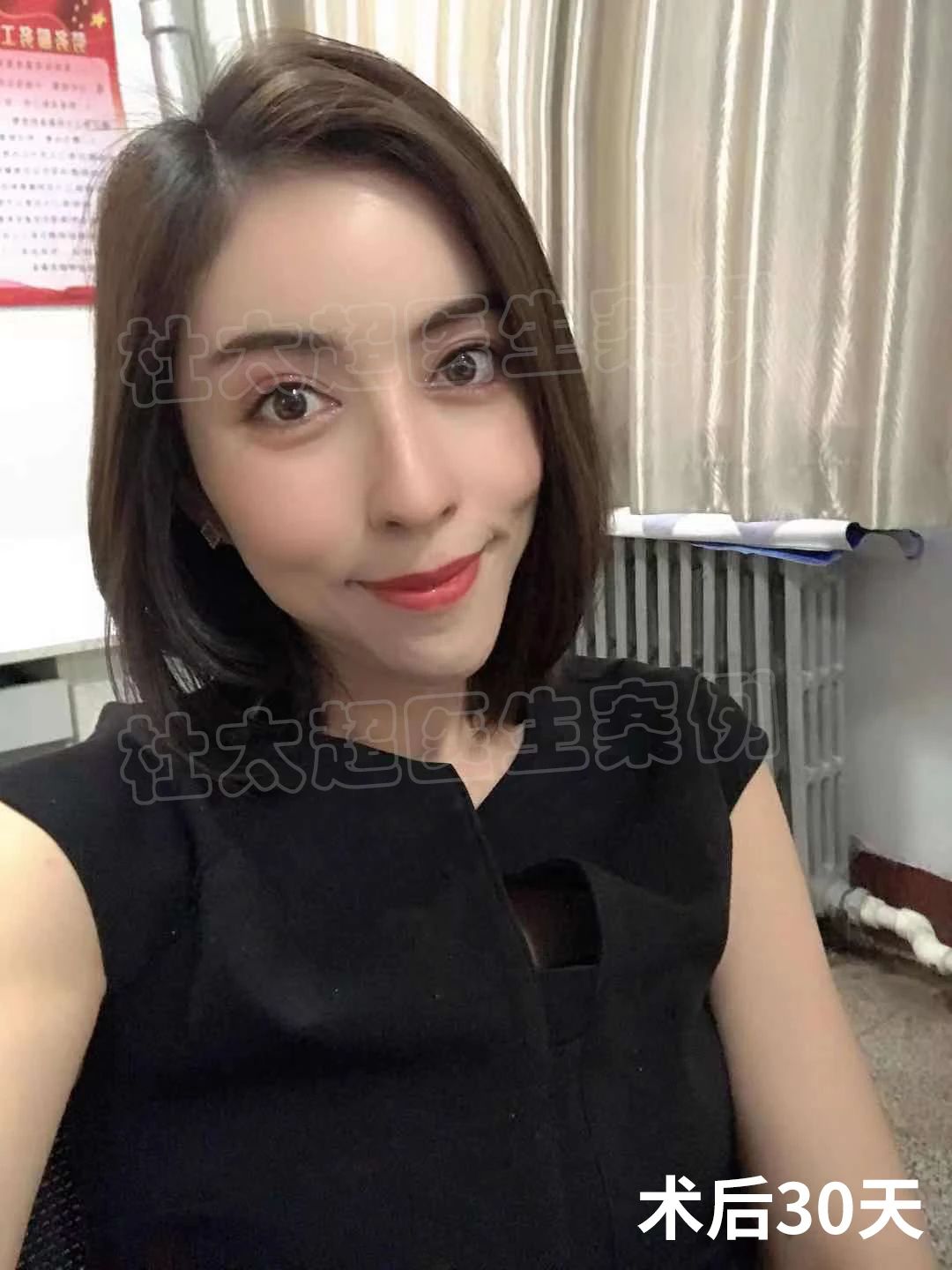案例分享|看看29岁是如何通过拉皮手术做到冻龄的！