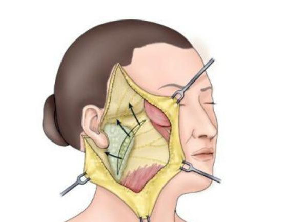 拉皮手术多少钱?1、2万能做拉皮吗? 拉皮手术多少钱?1、2万能做拉皮吗?
