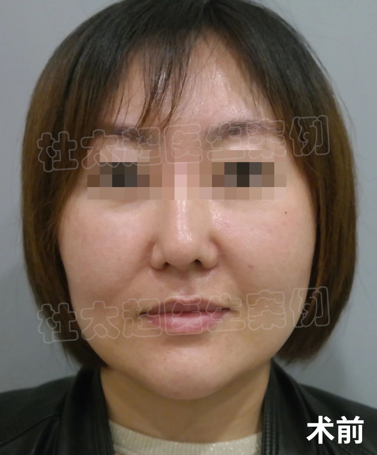 爱美才不是瞎折腾，36岁拉皮手术，结果出乎意料