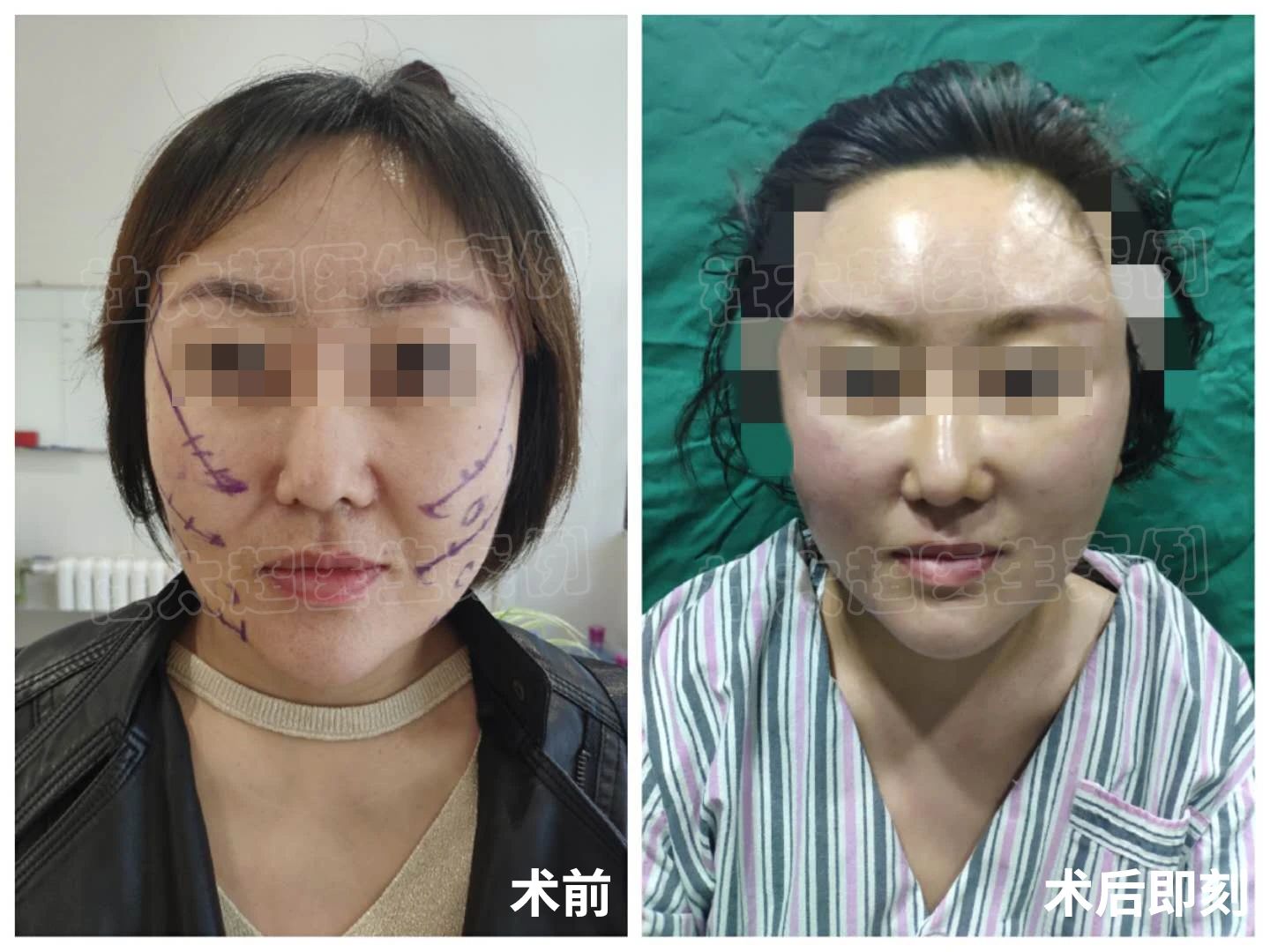 爱美才不是瞎折腾，36岁拉皮手术，结果出乎意料