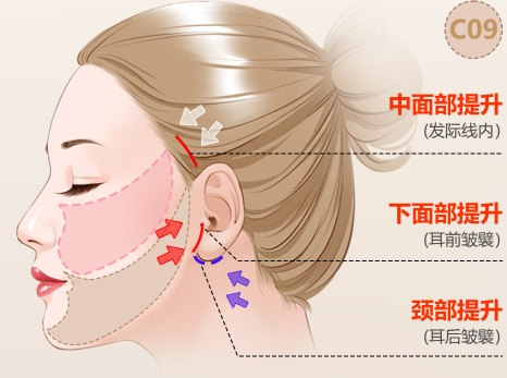 抗衰人士必看！拉皮手术的两种切口设计，各有千秋