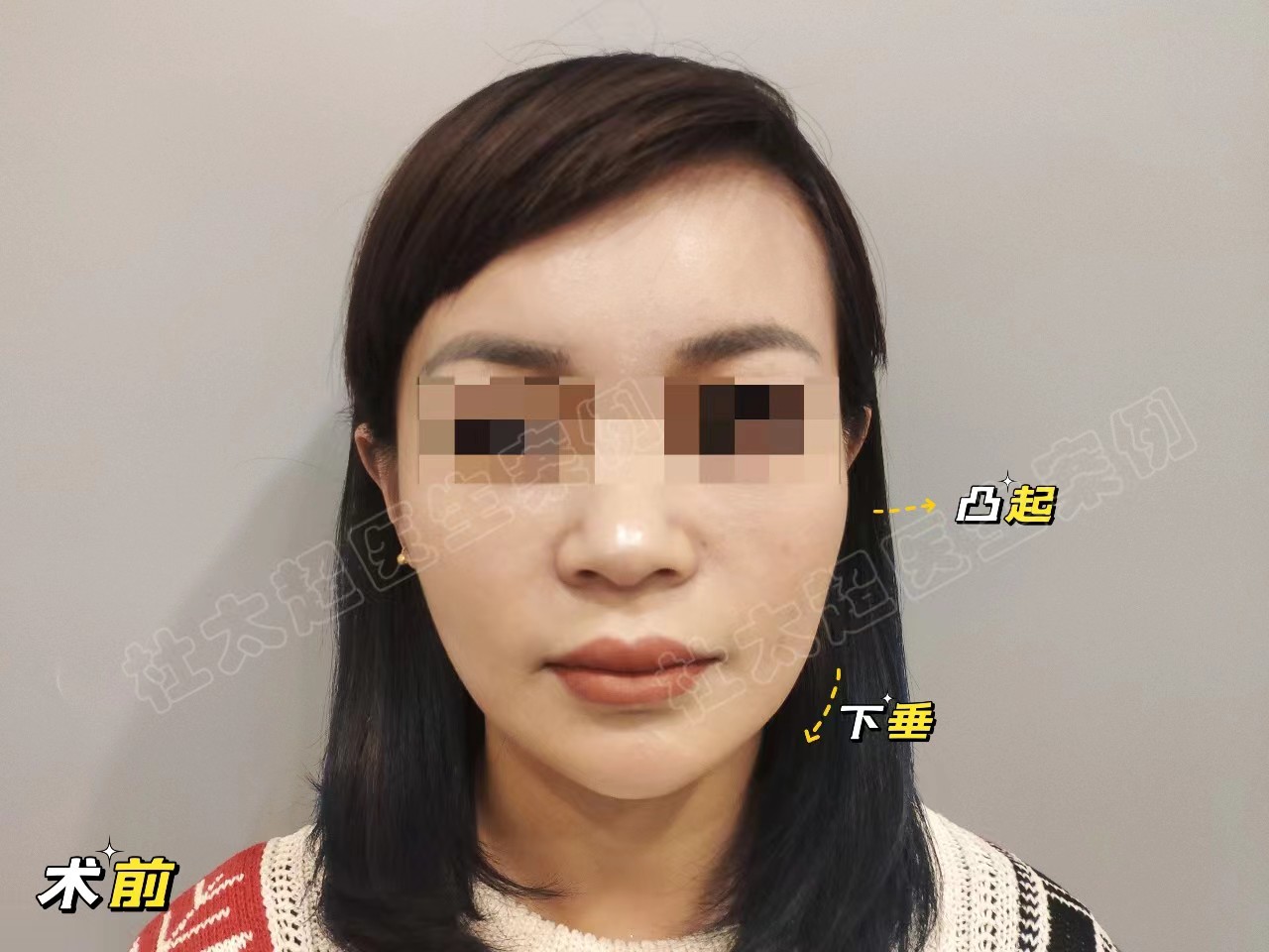 抗衰人士必看！拉皮手术的两种切口设计，各有千秋