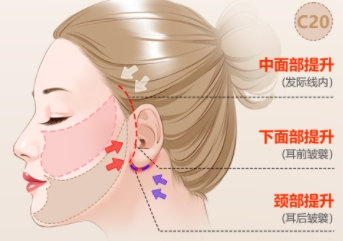 抗衰人士必看！拉皮手术的两种切口设计，各有千秋