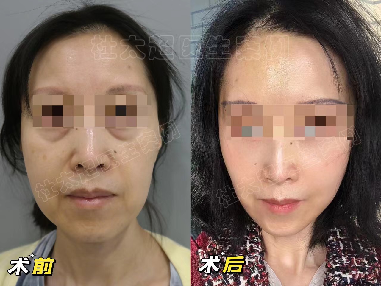 抗衰人士必看！拉皮手术的两种切口设计，各有千秋