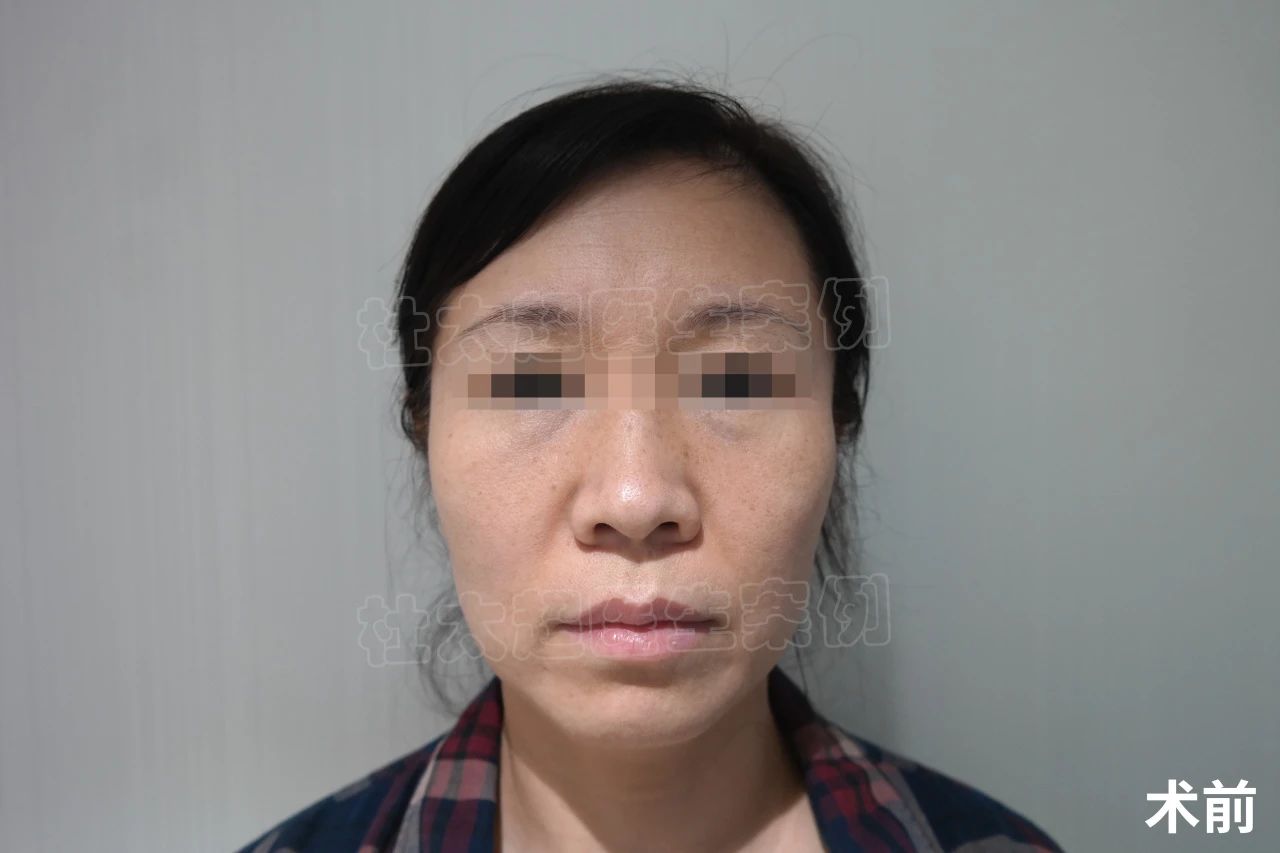 56岁求美者拉皮手术后,说了一句:真是白担心了 56岁求美者拉皮手术后,说了一句:真是白担心了