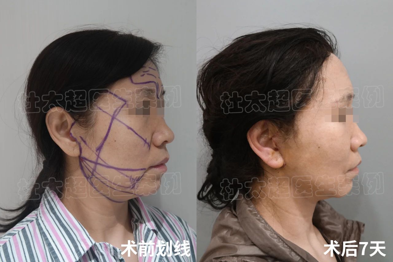 56岁求美者拉皮手术后,说了一句:真是白担心了 56岁求美者拉皮手术后,说了一句:真是白担心了