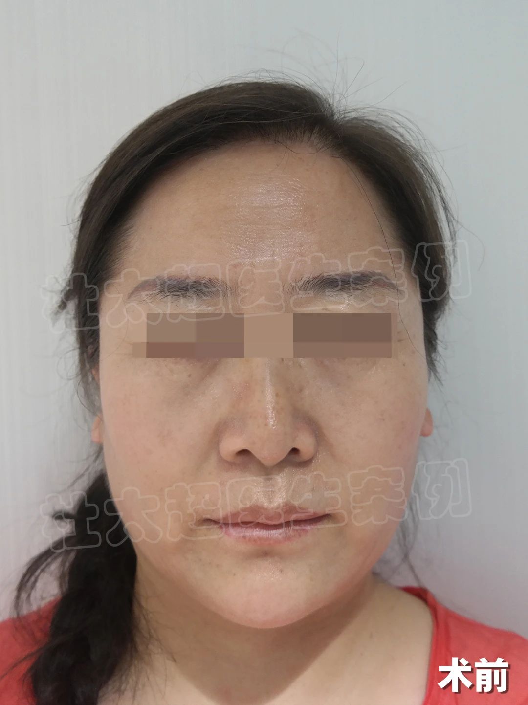 58岁拉皮手术日记，整形医生不会告诉的经历，我来分享你！