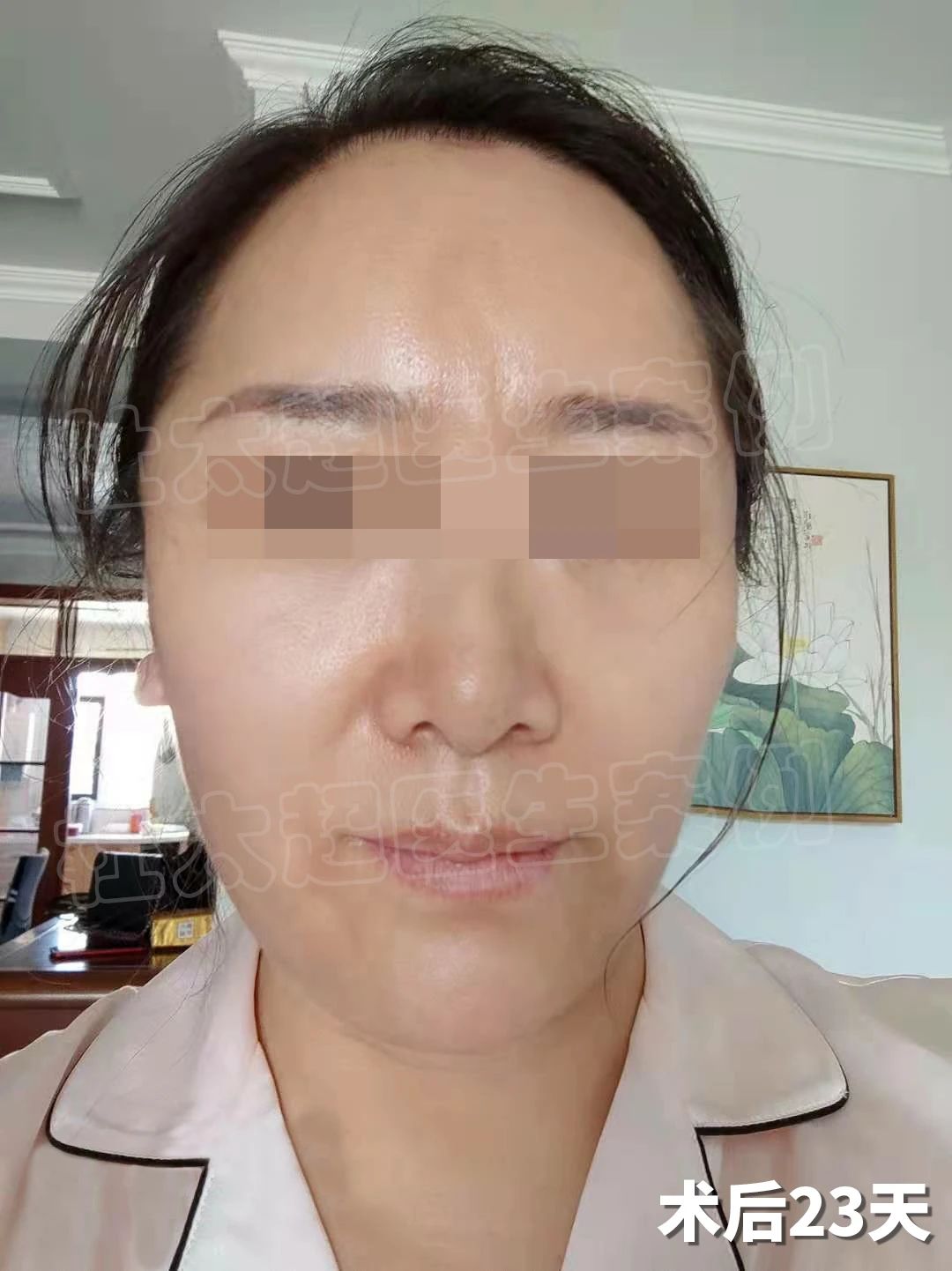 58岁拉皮手术日记，整形医生不会告诉的经历，我来分享你！