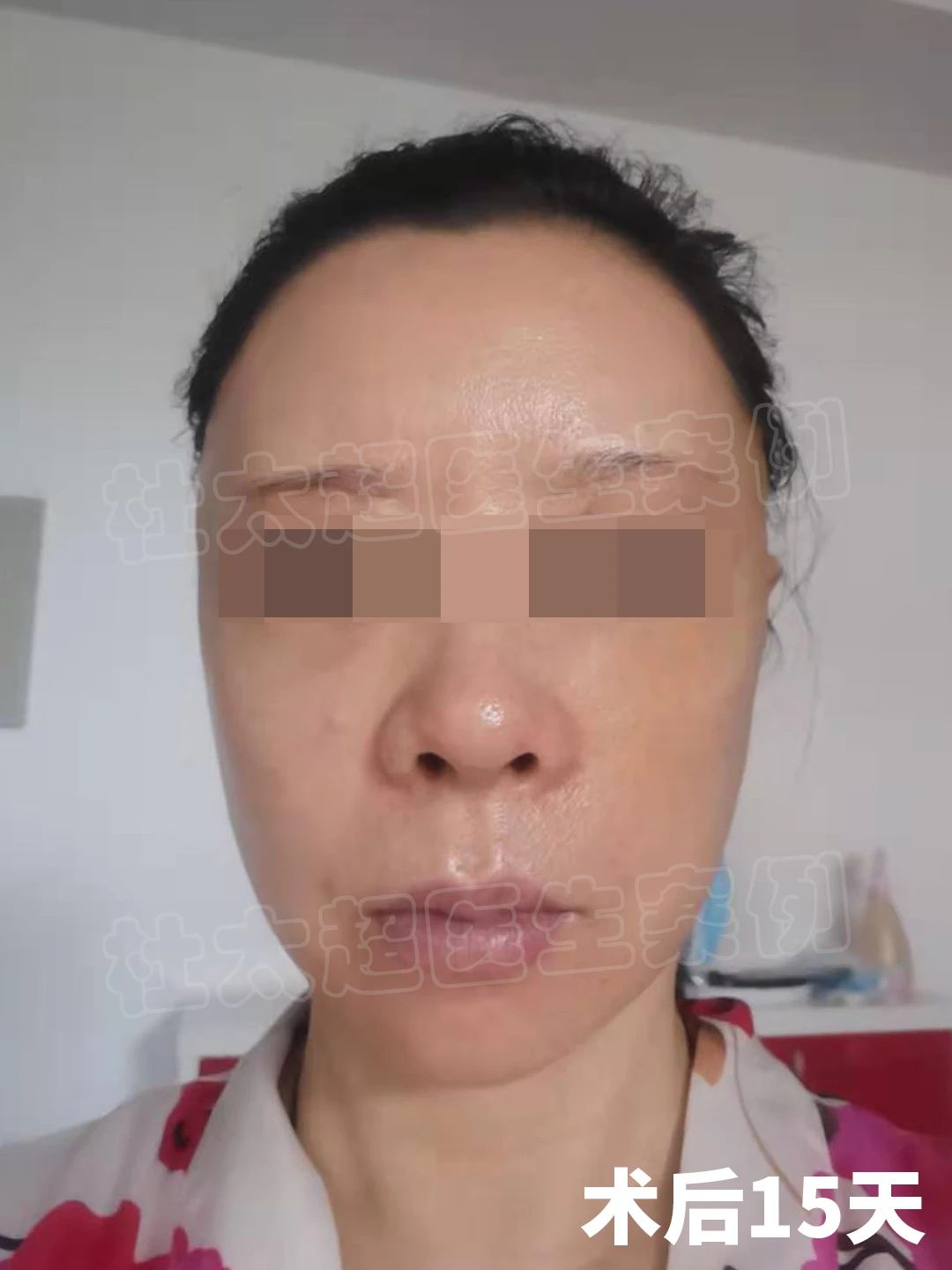 57岁拉皮手术,想说一些真心话,有可能得罪医生 57岁拉皮手术,想说一些真心话,有可能得罪医生