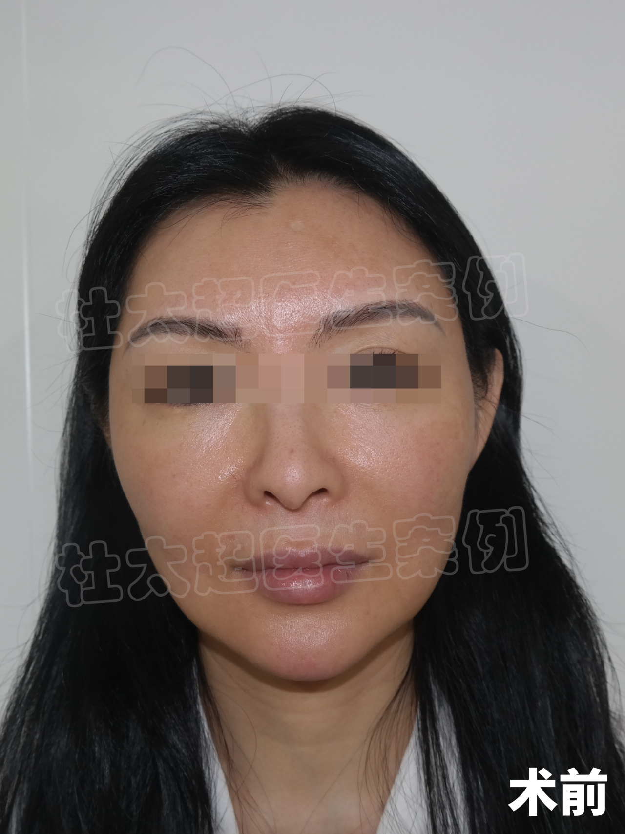 真实记录|45岁拉皮手术,术后表示很满意,安全变美不踩坑! 真实记录|45岁拉皮手术,术后表示很满意,安全变美不踩坑!