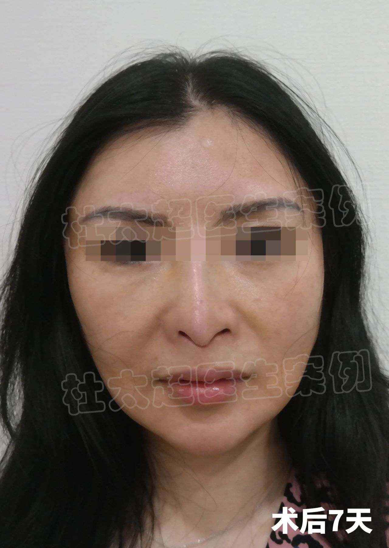 真实记录|45岁拉皮手术,术后表示很满意,安全变美不踩坑! 真实记录|45岁拉皮手术,术后表示很满意,安全变美不踩坑!