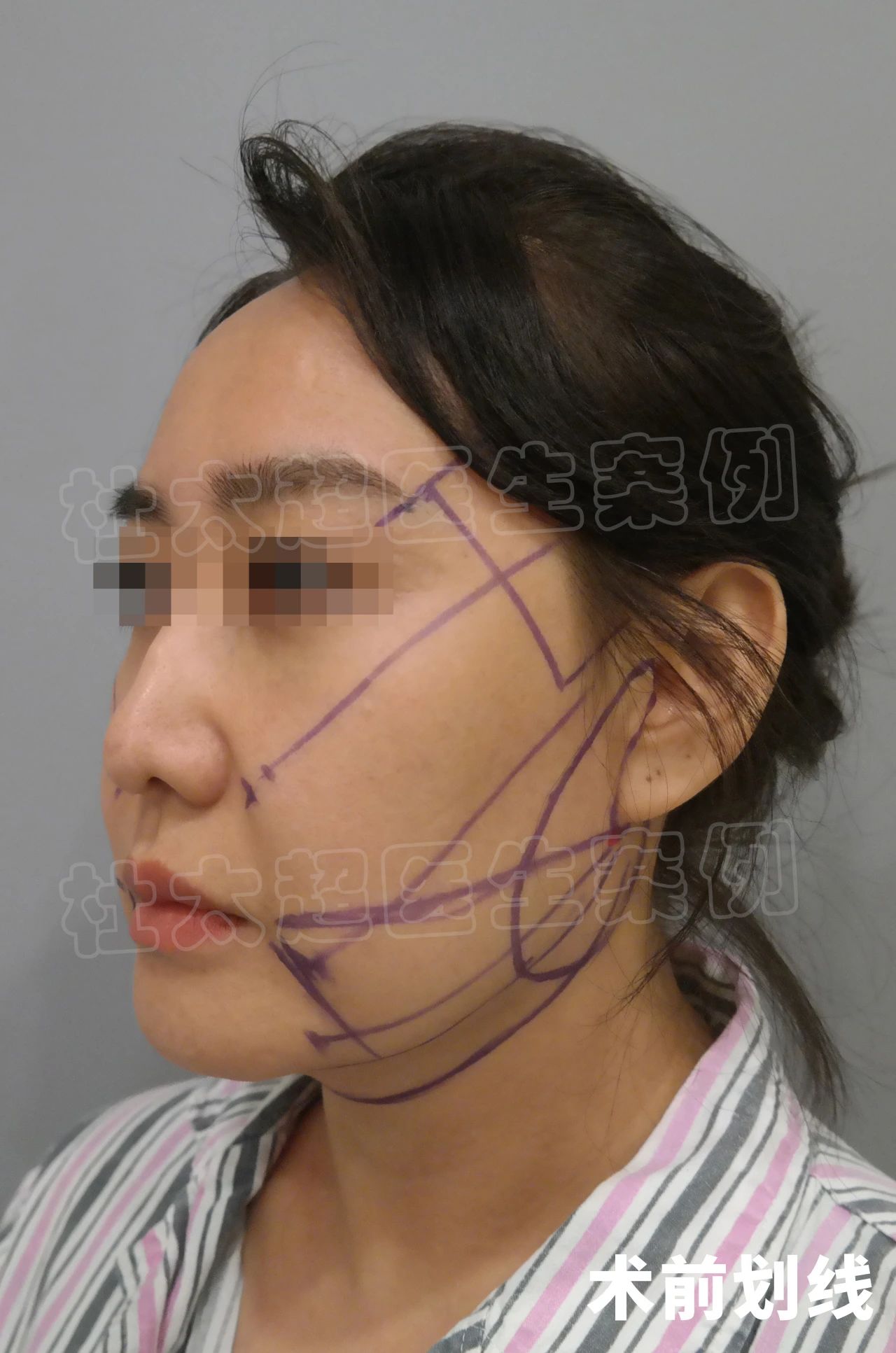 44岁就比同龄人显老,做完拉皮手术,直言:一切都很值得 44岁就比同龄人显老,做完拉皮手术,直言:一切都很值得