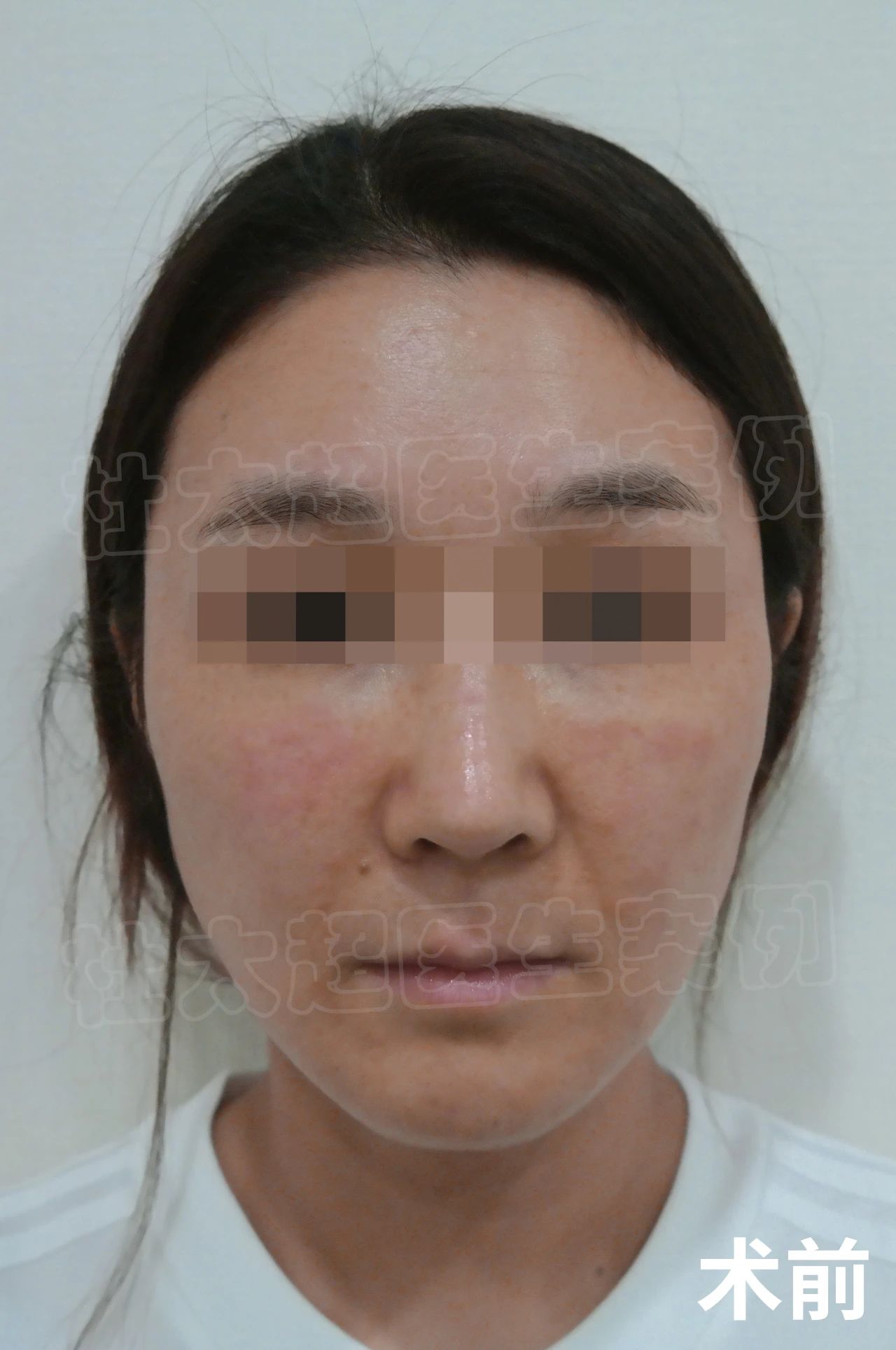 35岁求美者,做拉皮手术,术后效果让人眼馋! 35岁求美者,做拉皮手术,术后效果让人眼馋!