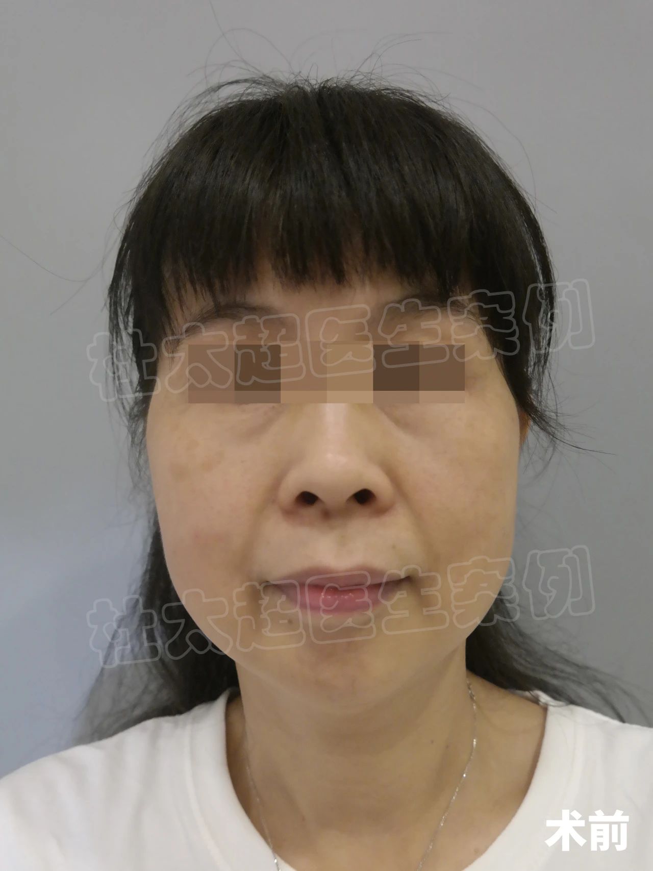 56岁老了吗？自卑到不敢出门，拉皮手术后找回自信！