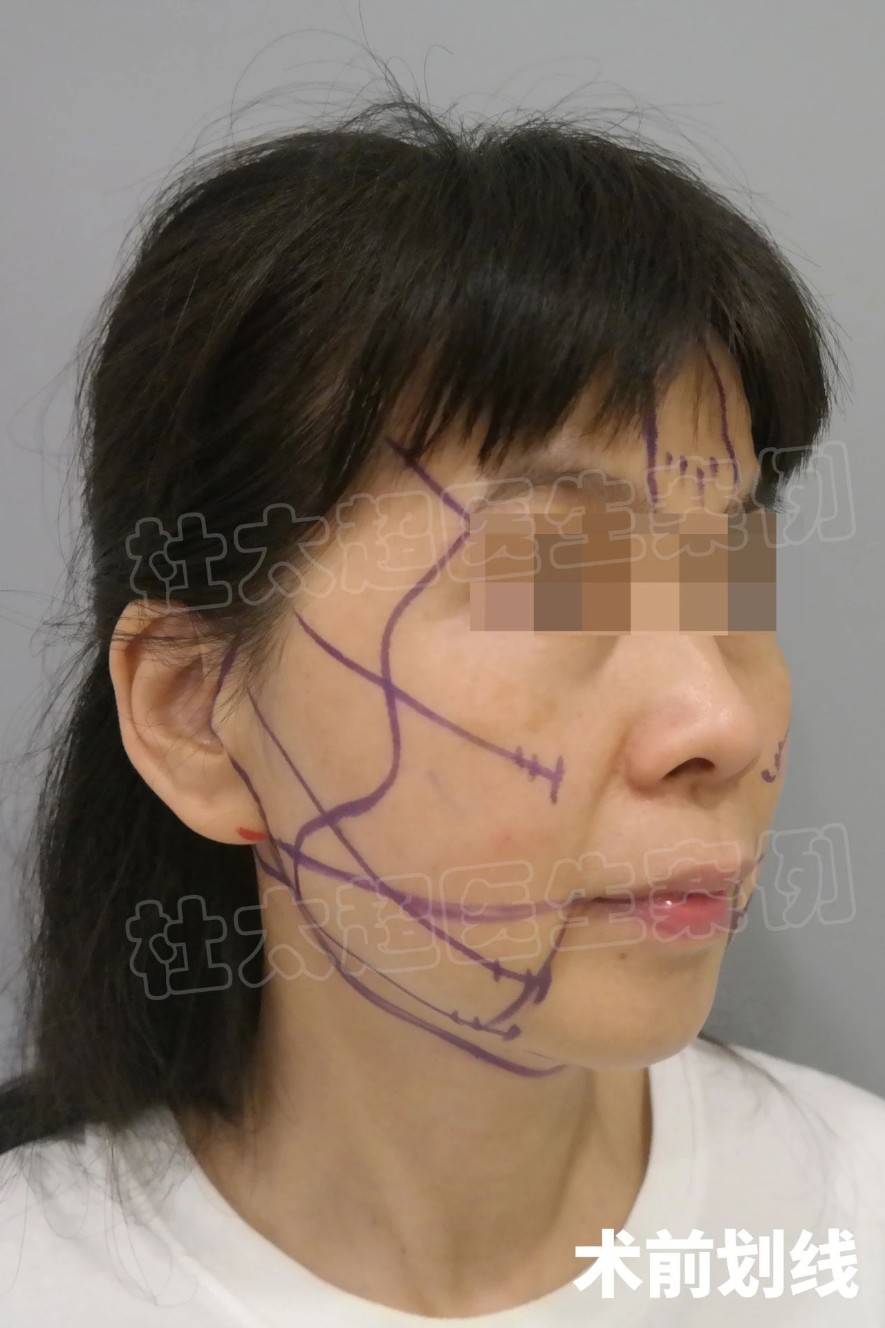 56岁老了吗？自卑到不敢出门，拉皮手术后找回自信！