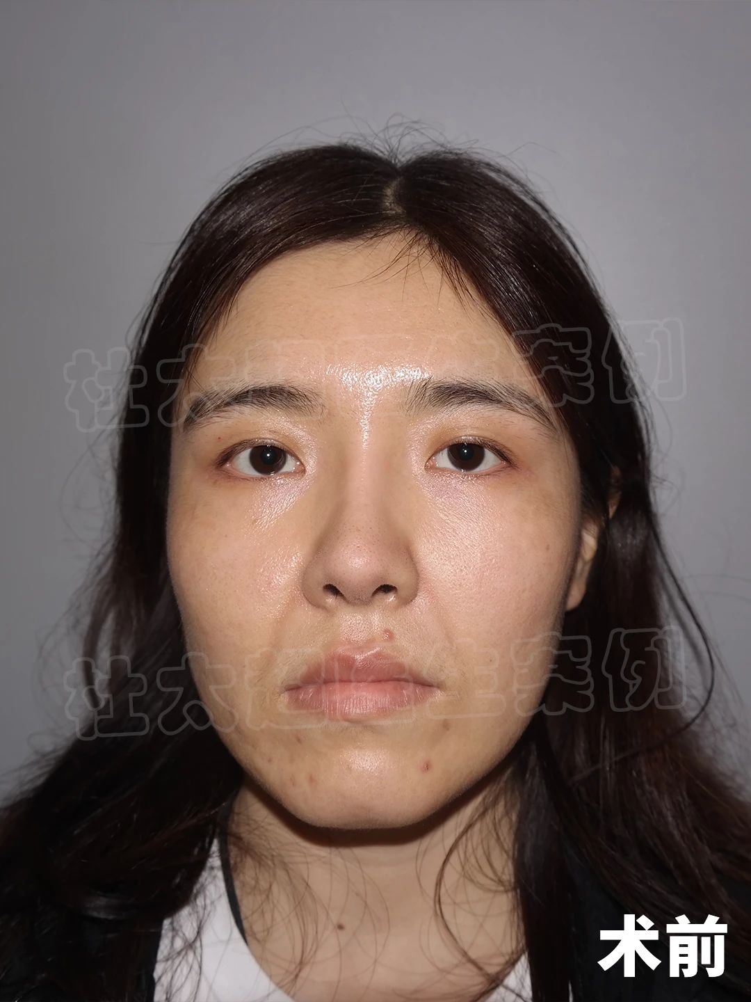 27岁拉皮手术，改善面部法令纹+苹果肌，术后效果太棒了